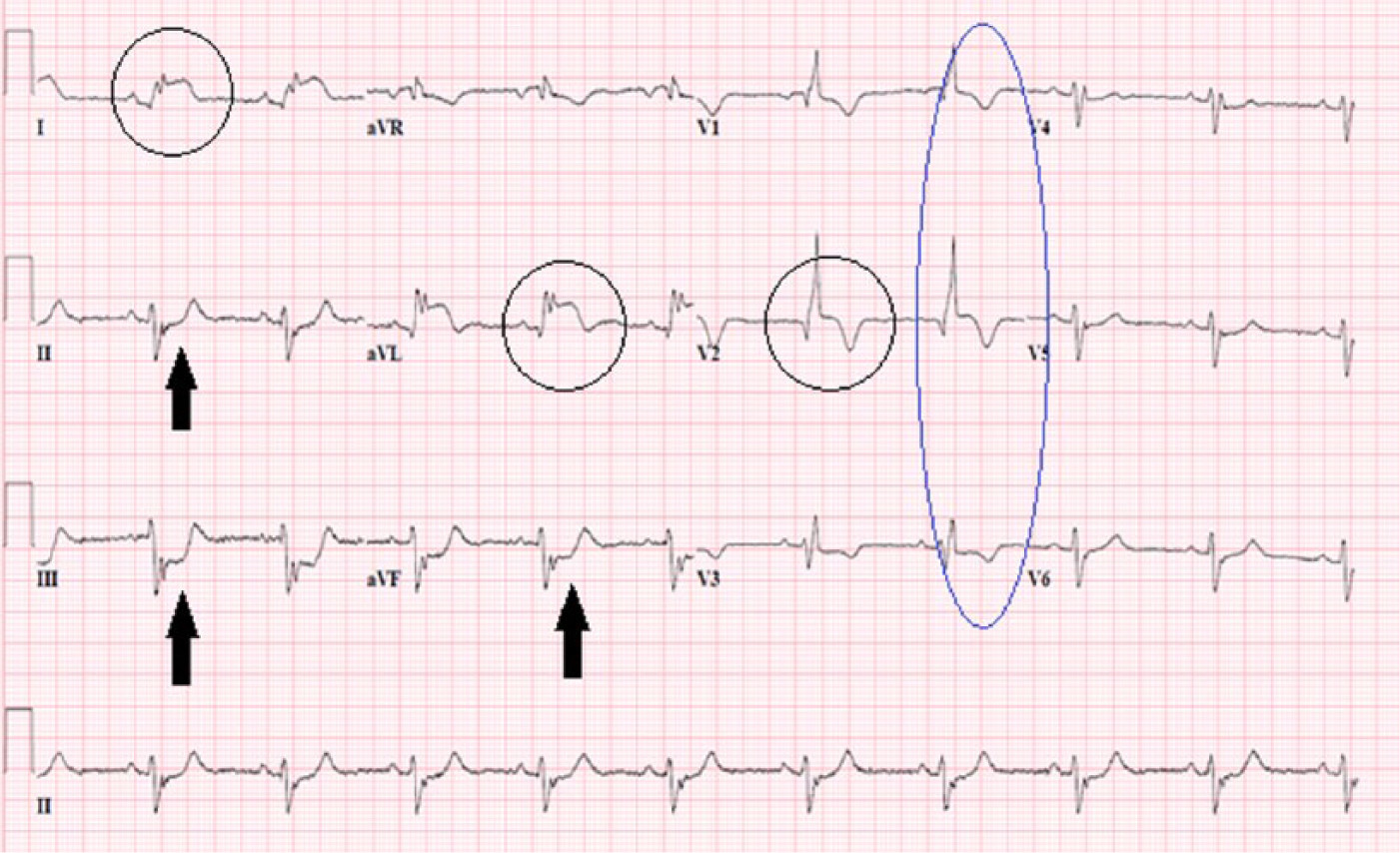 The Silent Threat Understanding Septal Infarct And Its Implications